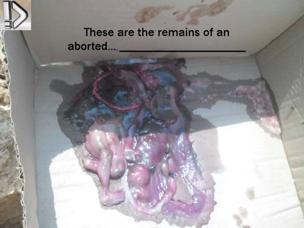 Aborted Baby2